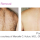 Illustration for article titled Smooth Clear Skin With Laser Hair Removal Des Plaines em/em